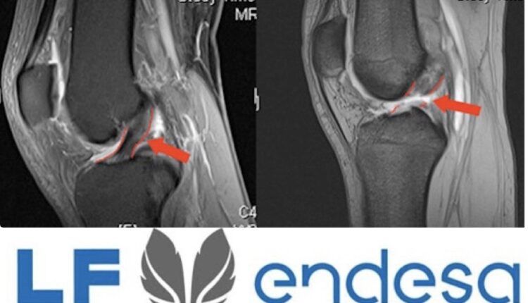 Rotura Ligamento cruzado anterior, Liga Femenina Endesa